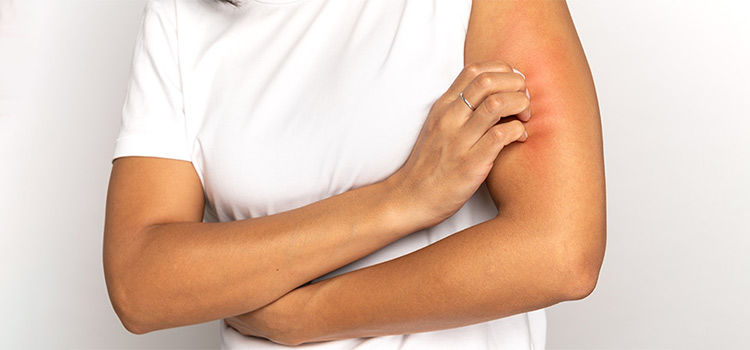 A woman showing red rashes on her arm