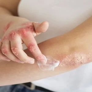 Eczema Solution Course Online